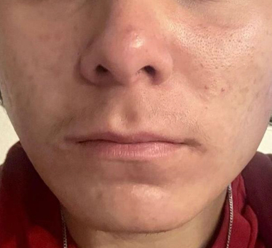 ACNE.A.SILVA.18.A