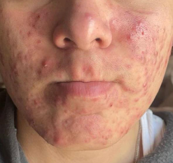 ACNE.A.SILVA.18.B