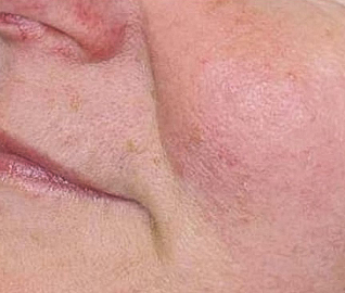 ROSACEA.D.CAMPOS.A