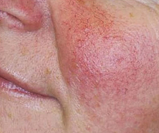 ROSACEA.D.CAMPOS.B